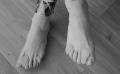 Silicone-teenorthese
