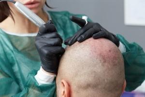 Tricopigmentatie