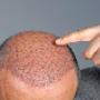Tricopigmentatie als aanvulling bij haartransplantatie