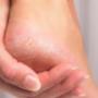 Pieds Bonheur crevasses aux pieds