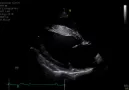 echografie hart